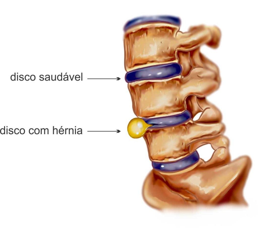 Hérnia de Disco
