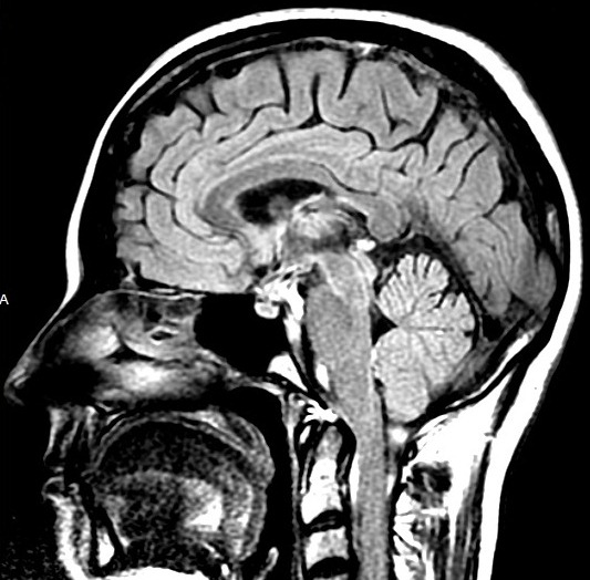 Neurocirurgia Oncológica